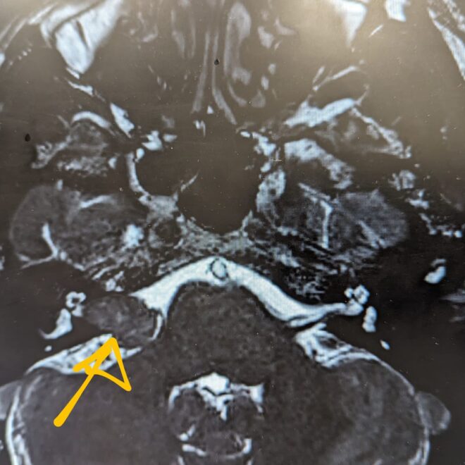 My Acoustic Neuroma Diagnosis Journey: From Subtle Symptoms to Life-Changing Clarity