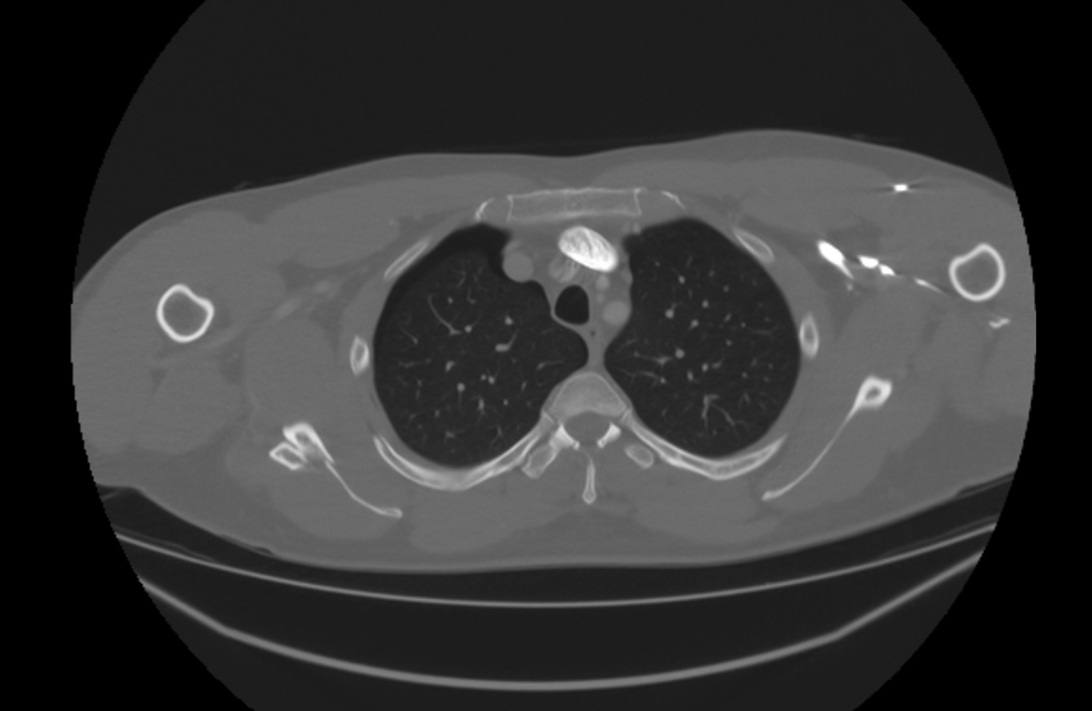Original axial bone-window CT showing fragments of the right scapular-body fracture