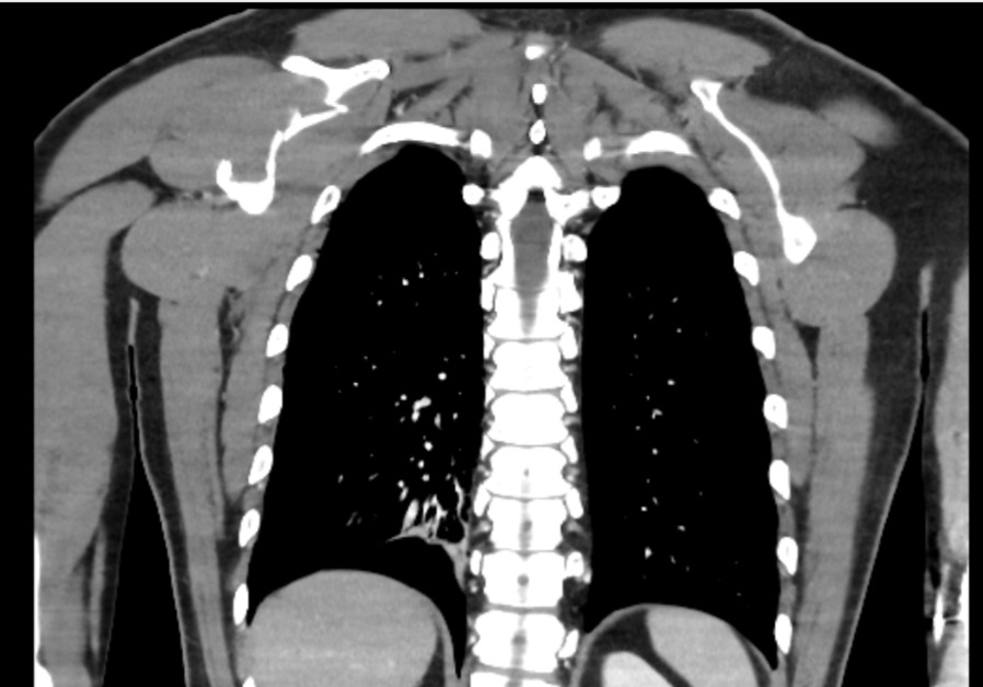 Original coronal bone-window CT showing the right scapular-body fracture