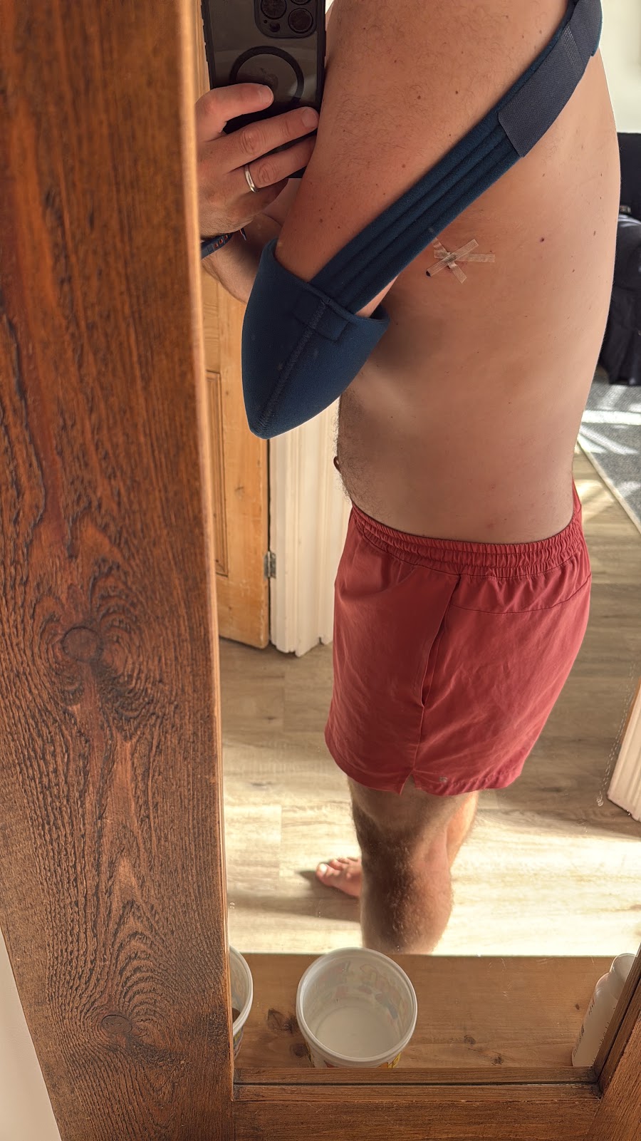 Side view showing the chest-drain wound healing during recovery