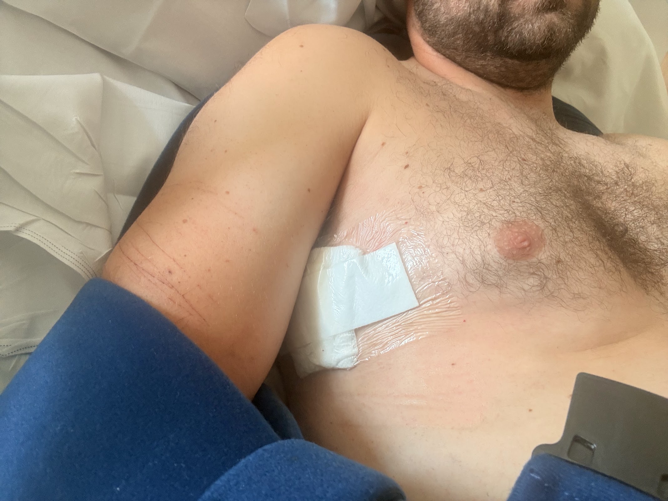 Initial dressing over the right chest drain site shortly after the drain was removed