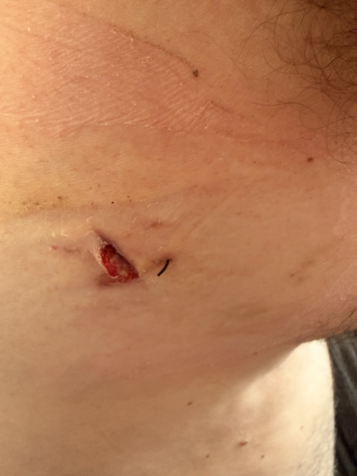 Chest drain wound during the first dressing change after leaving hospital