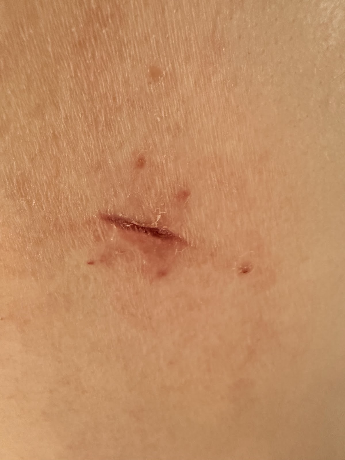Healing scar at the former right chest drain site in August 2026