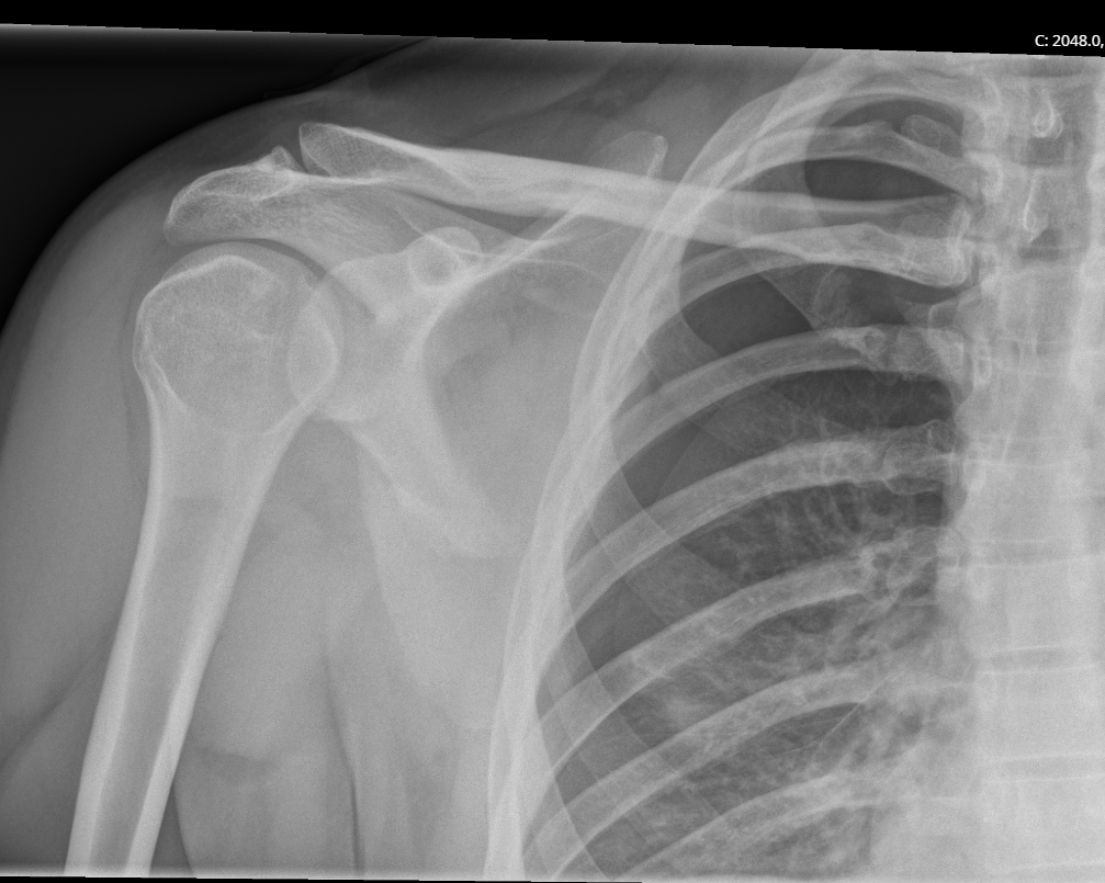 Pre-drain X-ray showing the right pneumothorax before treatment