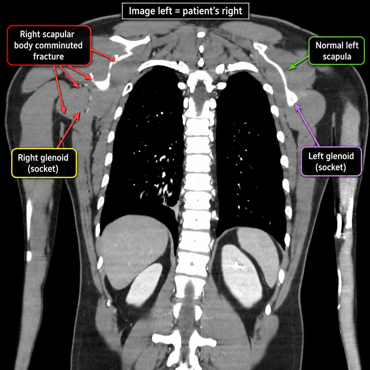 Annotated coronal CT showing the comminuted right scapular-body fracture