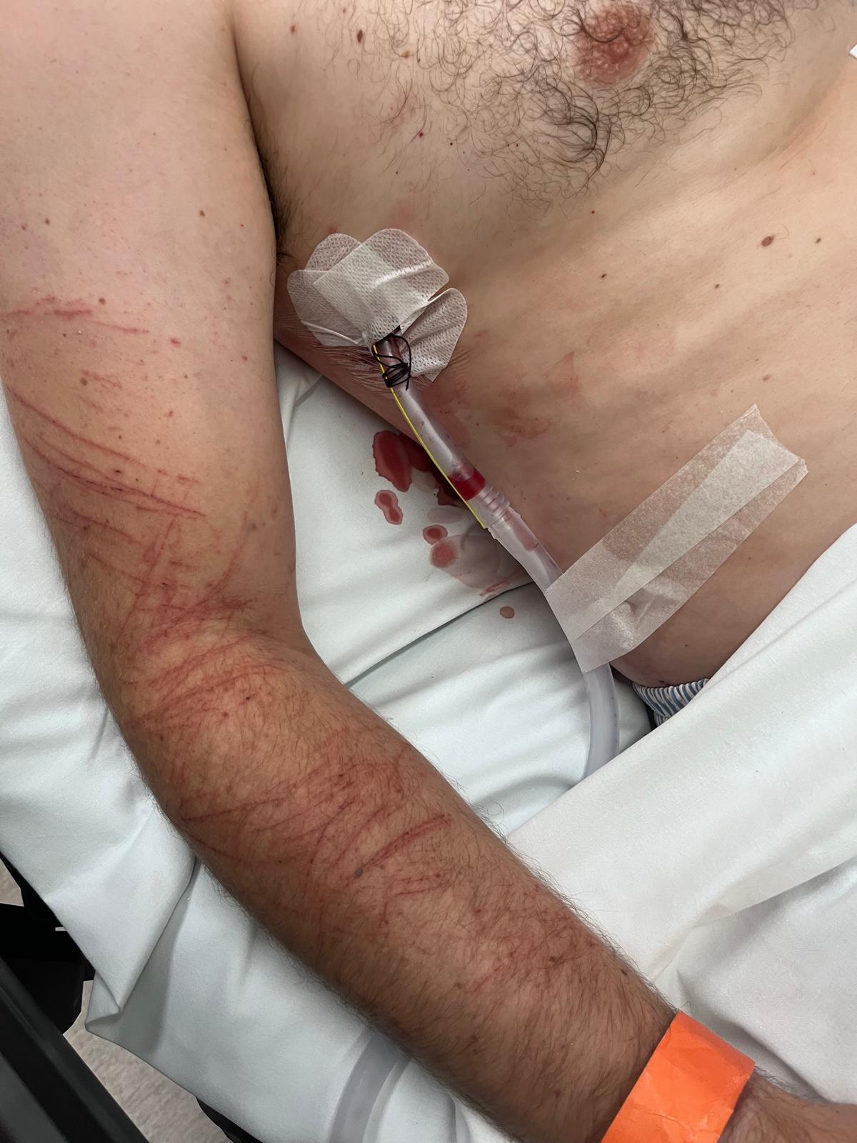 Chest drain inserted into the right side of the chest during the hospital admission