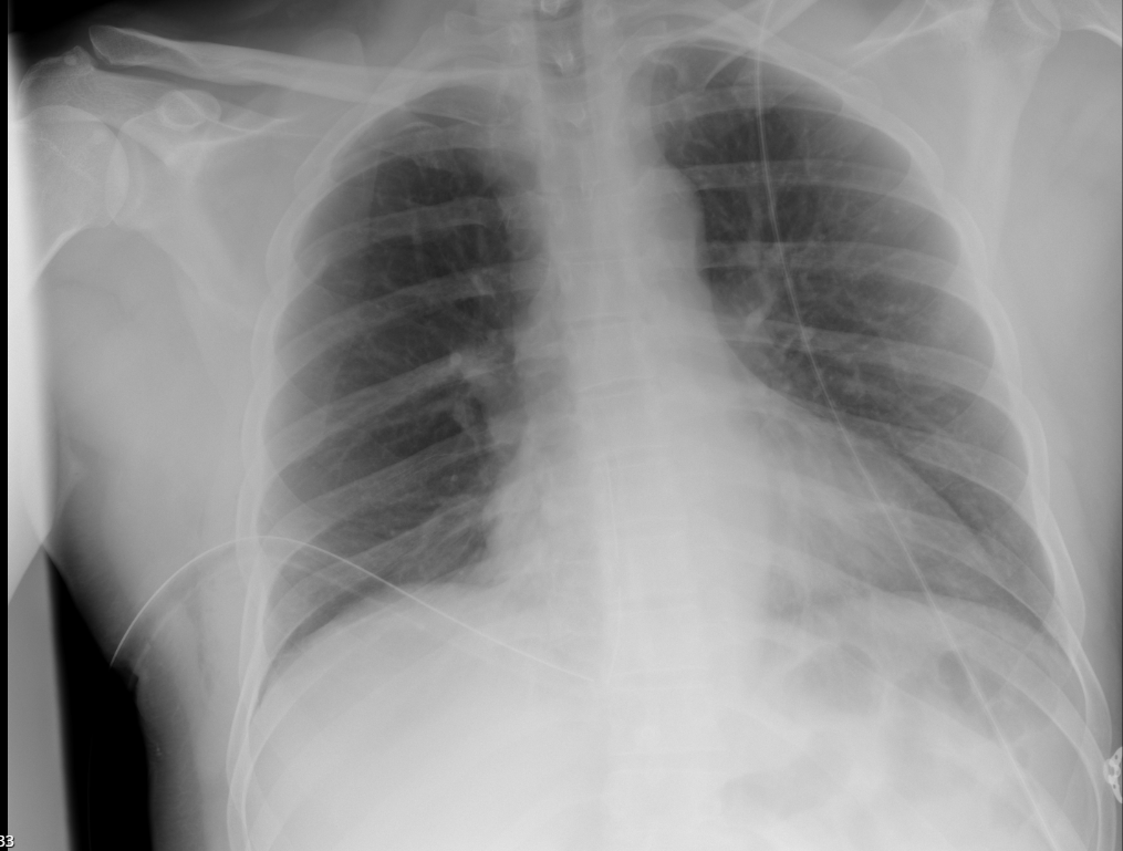 Post-drain chest X-ray showing the chest drain and re-expanded right lung